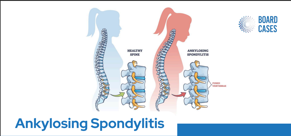Ankylosing Spondylitis