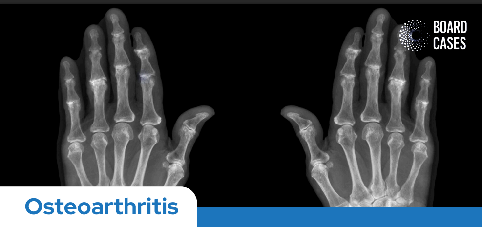 Osteoarthritis