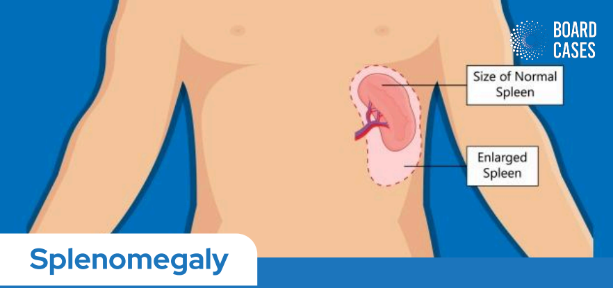 Splenomegaly