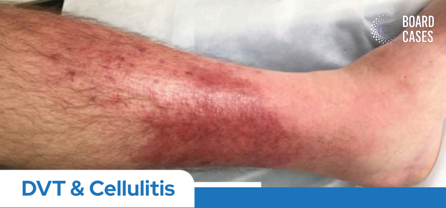 DVT & Cellulitis
