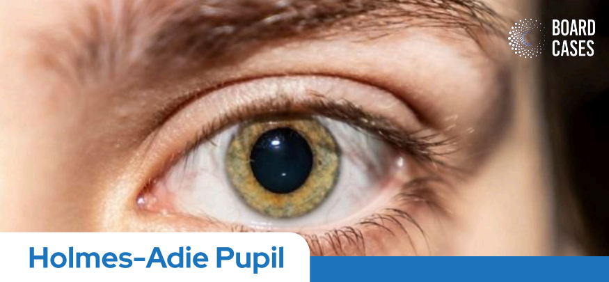 Holmes-Adie pupil