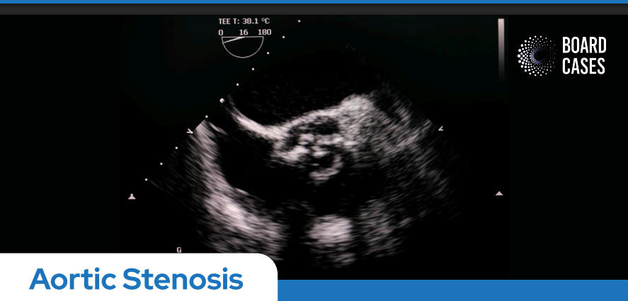 Aortic Stenosis