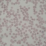 Spherocytosis agglutination & AIHA