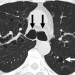 Hemoptysis or chronic cough