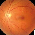 Dm Retinopathy