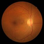 Htn Retinopathy