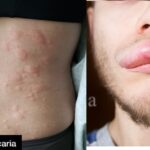 Angioedema