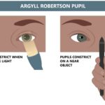 Argyll Robertson pupil