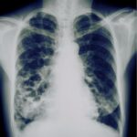 Bronchiectasis