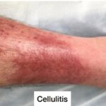 DVT & Cellulitis