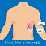 Splenomegaly