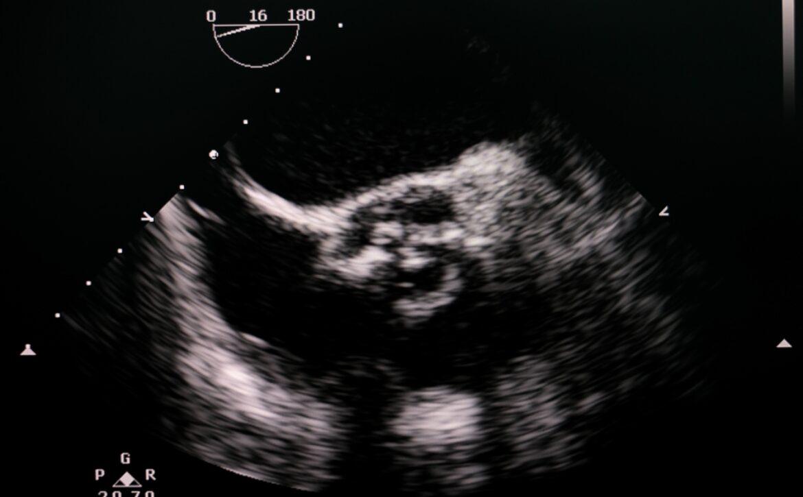 Transesophageal,Echocardiogram,Showing,Calcified,Severe,Aortic,Valve,Stenosis