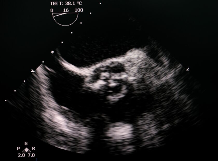 Transesophageal,Echocardiogram,Showing,Calcified,Severe,Aortic,Valve,Stenosis