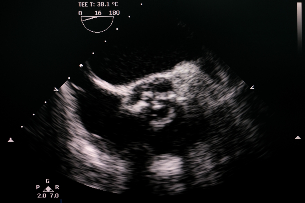 Transesophageal,Echocardiogram,Showing,Calcified,Severe,Aortic,Valve,Stenosis