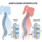 Ankylosing spondylitis